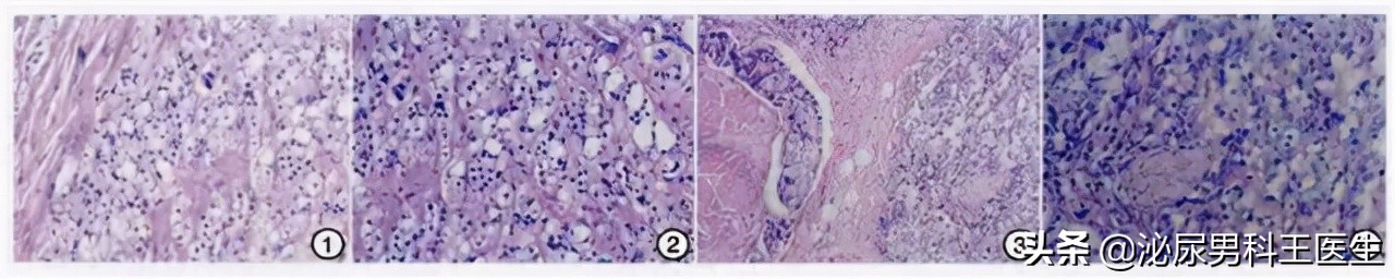 为什么年轻人会得前列腺癌,为什么年轻人会得前列腺炎