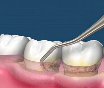 牙齿松了可以做补齿吗,牙松了用冷酸灵能固齿
