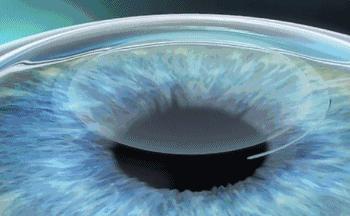 近视飞秒和icl晶体哪个好,全飞秒和icl哪个危害大