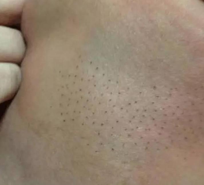 孩子背上长出“怪毛”,妈妈直接薅断,不料把娃薅进了ICU