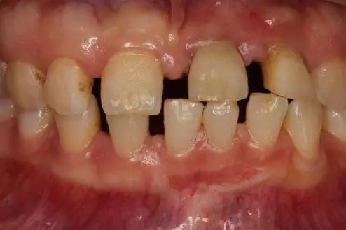 孩子牙齿不齐需要矫正吗,孩子牙齿不齐矫正有必要吗