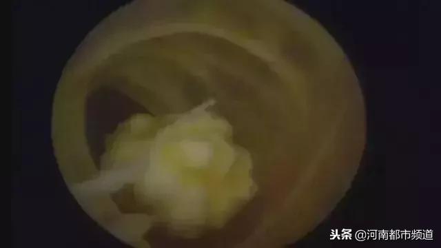 老人膝盖软骨磨没了最佳治疗方案,老年人膝关节软骨退化怎么办