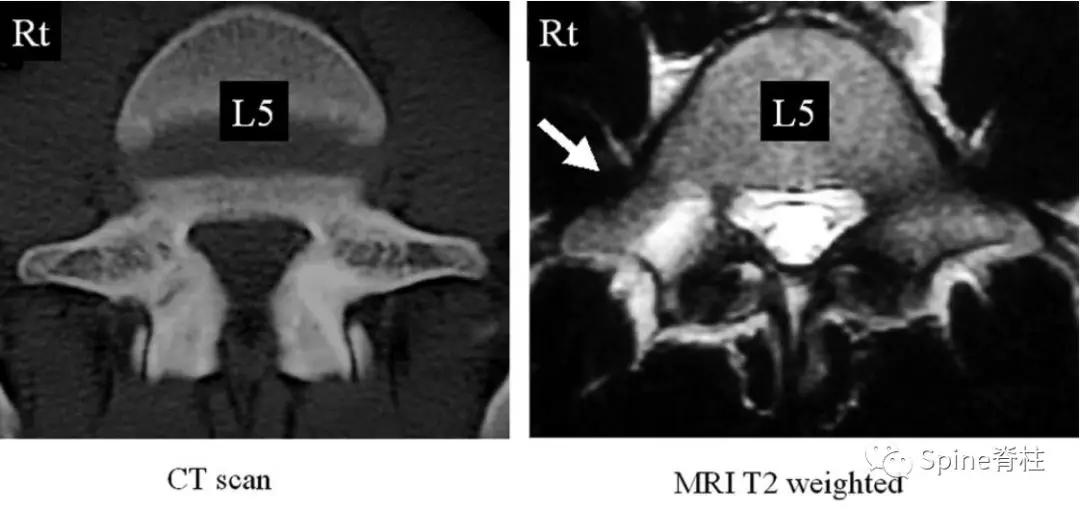 青少年一跑步就腰痛,青少年腰痛是什么原因引起的