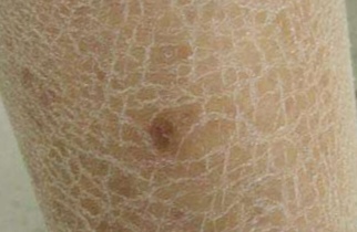 燥痹的症状和治疗方法,燥痹中医诊断标准