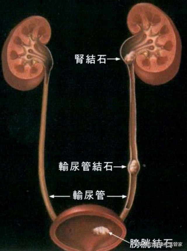 怎么断定得了尿路结石,得了尿道结石什么症状
