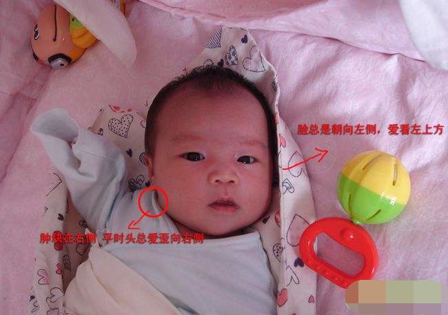小儿歪脖怎么引起的,婴儿歪脖是什么原因引起的