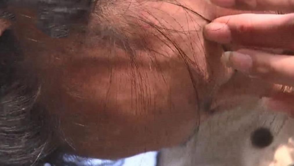 花19.9元在美容院按脸后，一根血管爆出来了？店长：美容师辞职了