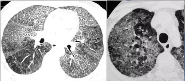 肺部ct十大征象,肺部ct正常图和异常图的区别
