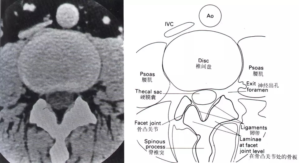 颈椎腰椎疾病ct及mri诊断,腰椎ct可以发现肠部病变吗