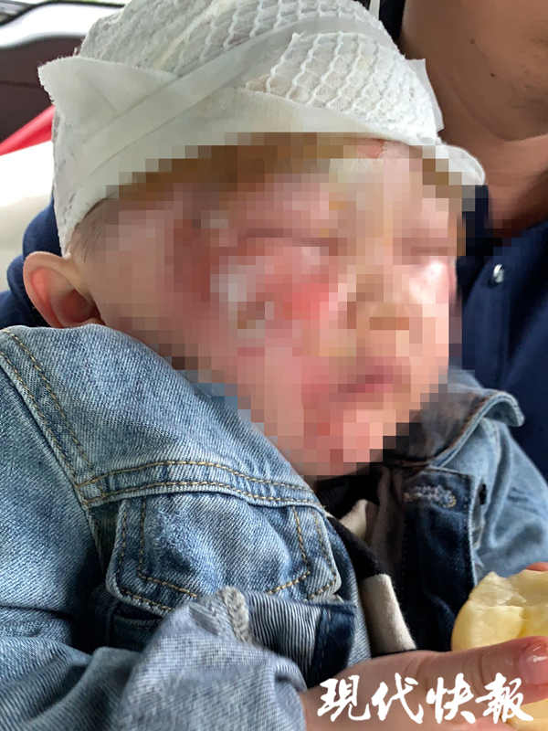 小孩脸上被烫伤了肿得厉害,2岁宝宝脸被开水烫伤
