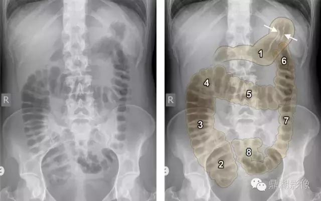 X线高清图谱|精致腹部解剖
