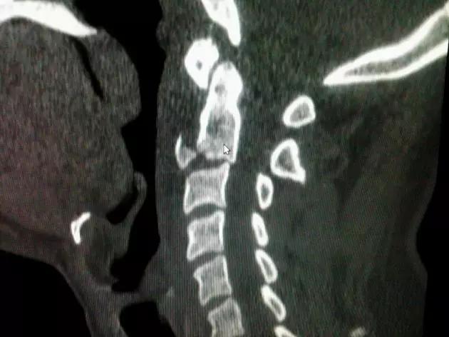 特殊骨折类型,特殊骨折体征