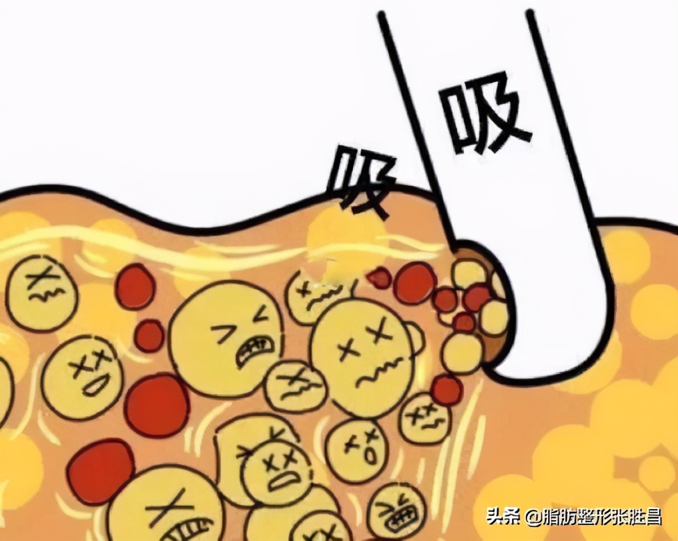 去医院做抽脂怎样才不会被坑,我想去做个腹部抽脂减肥手术