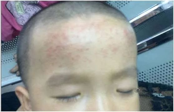 儿童退热贴骗局揭秘,用退热贴真的好吗