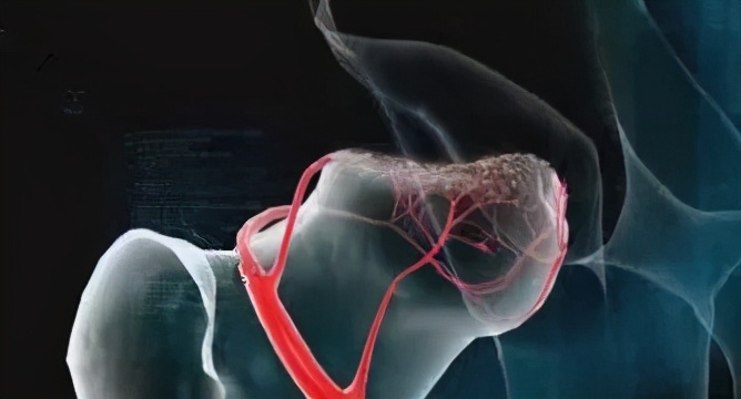 股骨头坏死怎样疏通血管,股骨头坏死血管融通术效果好吗