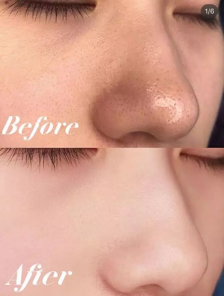 男生螨虫脸特征,螨虫脸的特征