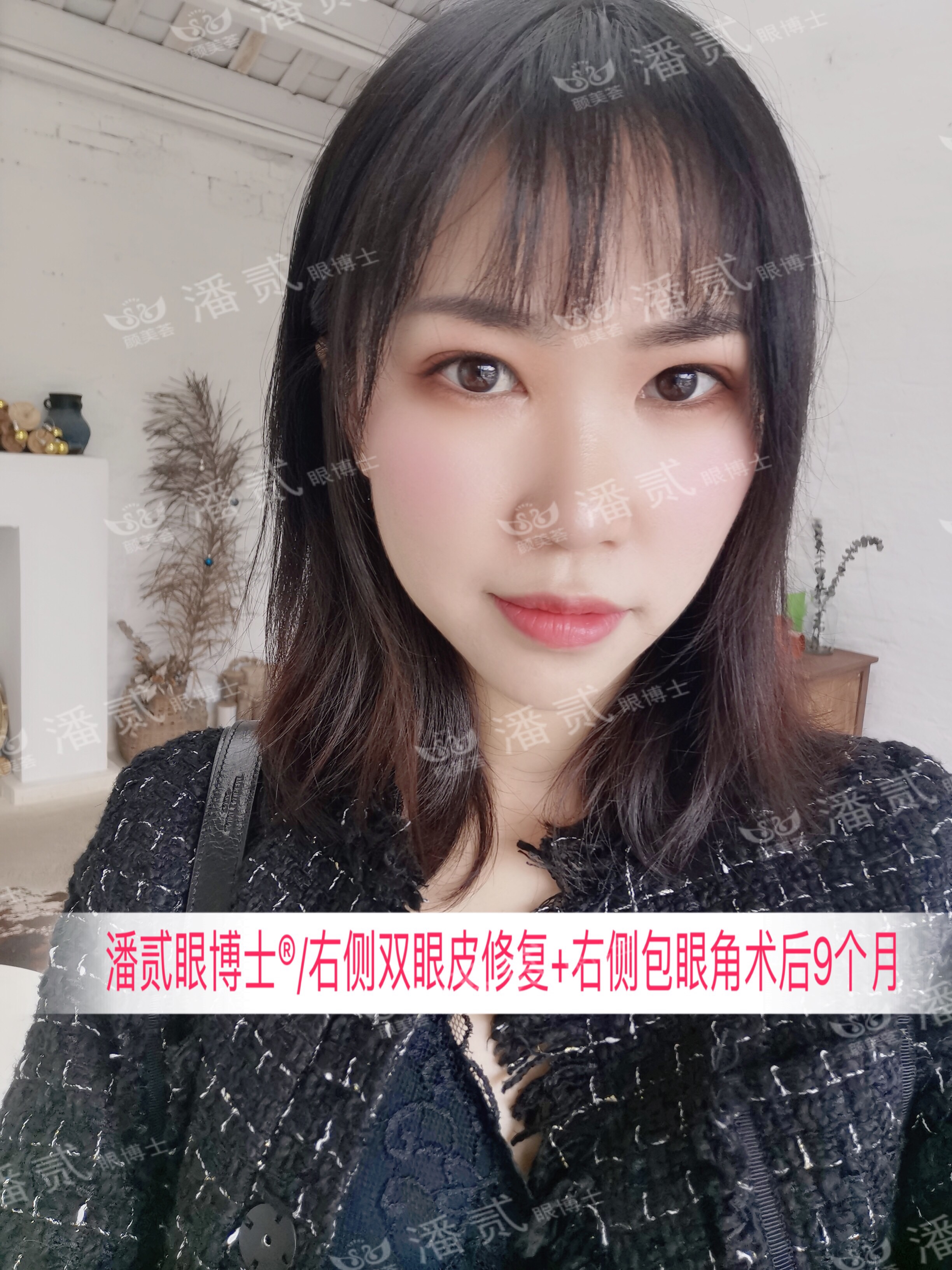 开内眼角会留疤的照片,开内眼角的疤痕变白色了怎么办