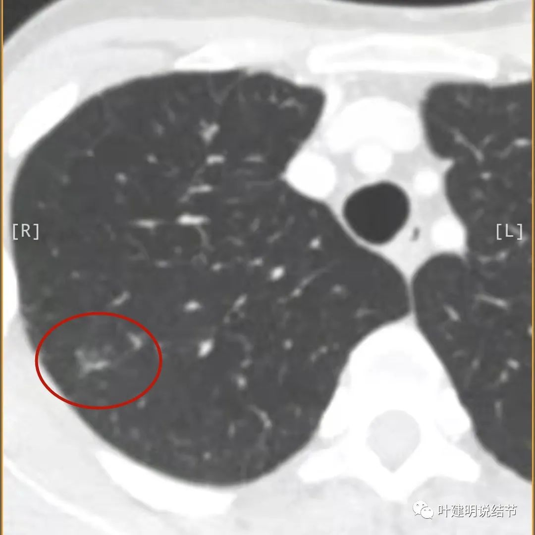 临床诊断孤立性肺结节,空洞型结节一般是什么性质