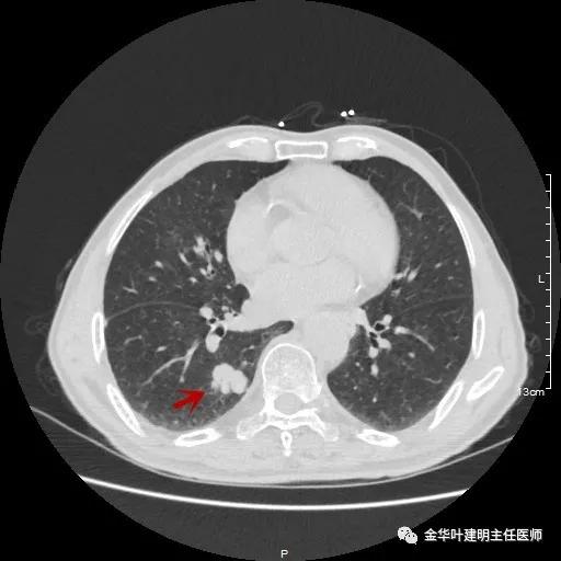 多发原发肺癌能根治吗,肺部原发性恶性肿瘤好治