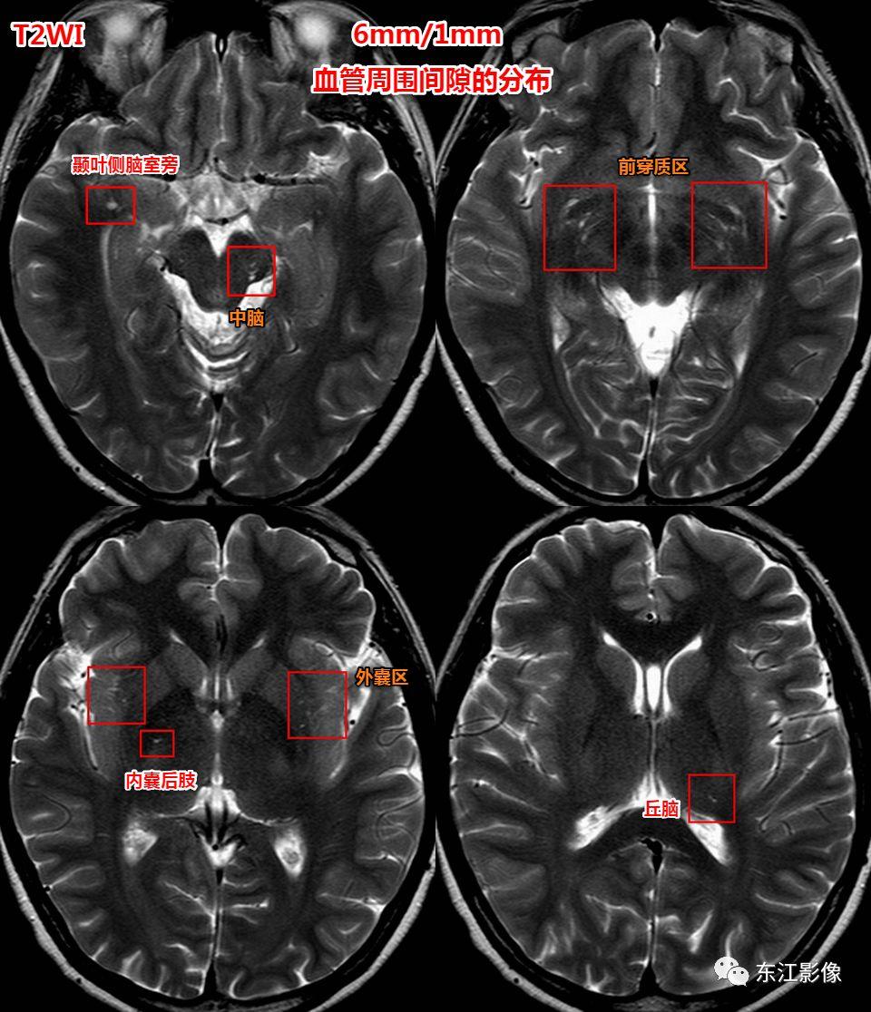 头颅mri扫描影像哪里找,头颅影像mra详细解说