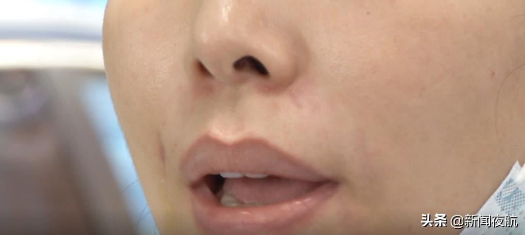 花了300万做全脸填充,花了1万4做了面部填充