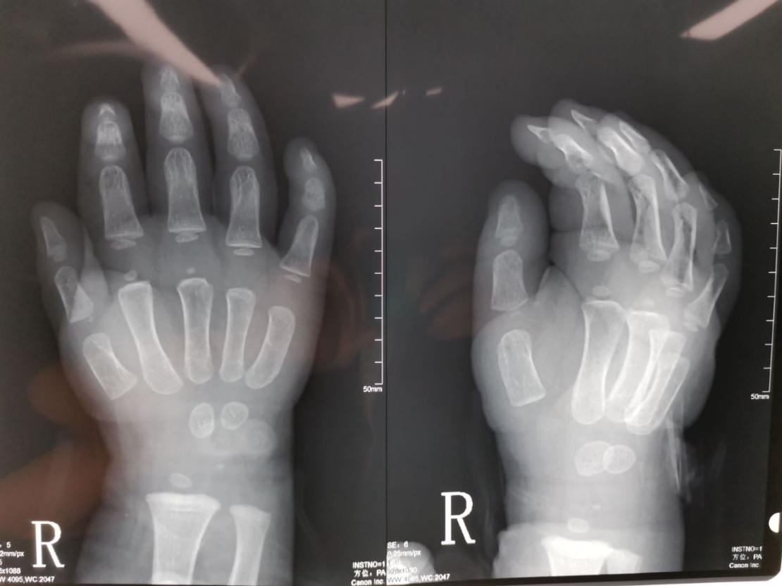 并指畸形免植皮案例,并指畸形