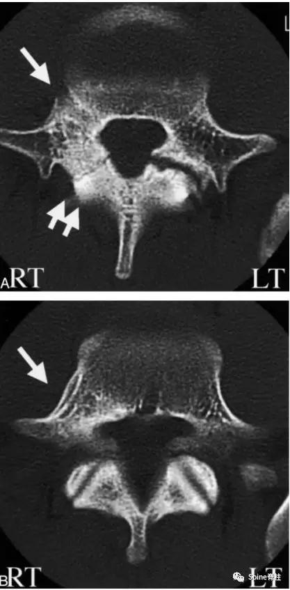 青少年一跑步就腰痛,青少年腰痛是什么原因引起的