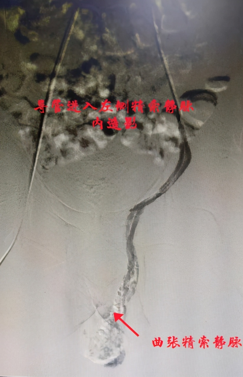 小伙子兵检不合格,当兵血管瘤不合格可以复检吗