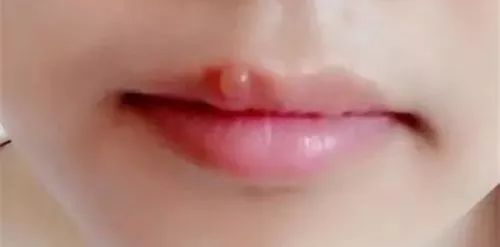 孕期嘴角起小水泡最快消除方法,孕早期嘴角起大水泡最快消除方法