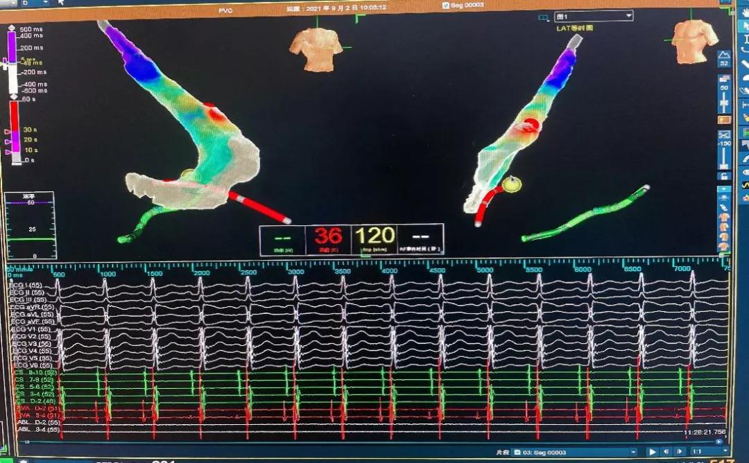 北京安贞医院室上速射频消融手术,北京阜外医院房颤射频消融术