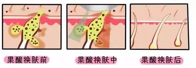 果酸换肤对哪种痘坑有效,果酸换肤对脂肪粒有效吗
