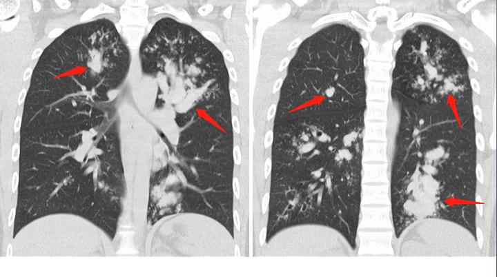 闻发霉的米饭会得霉菌性肺炎吗,发霉的果蔬馒头
