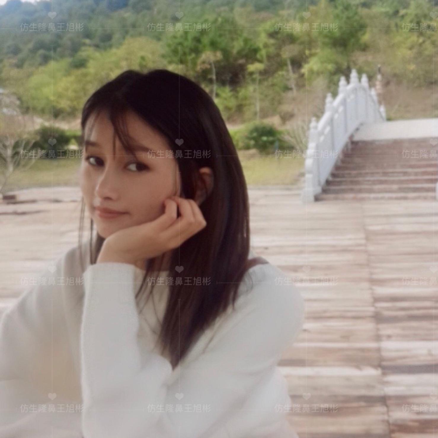 山根低鼻头大隆鼻,鼻根很低的隆鼻后的效果