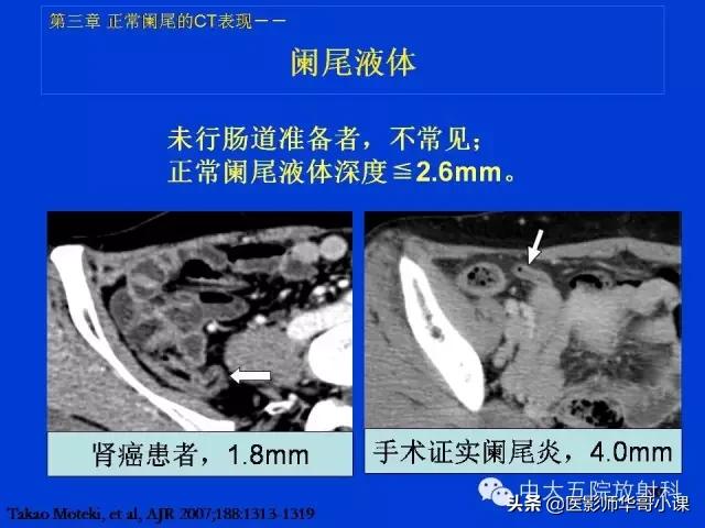 阑尾炎课件,阑尾炎的超声课件