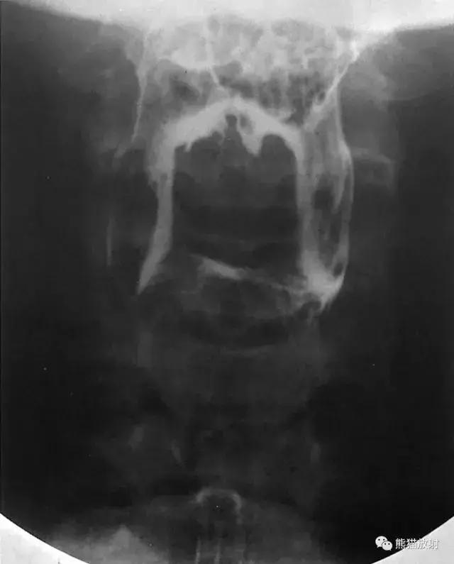 「收藏」11种消化道造影解剖图谱