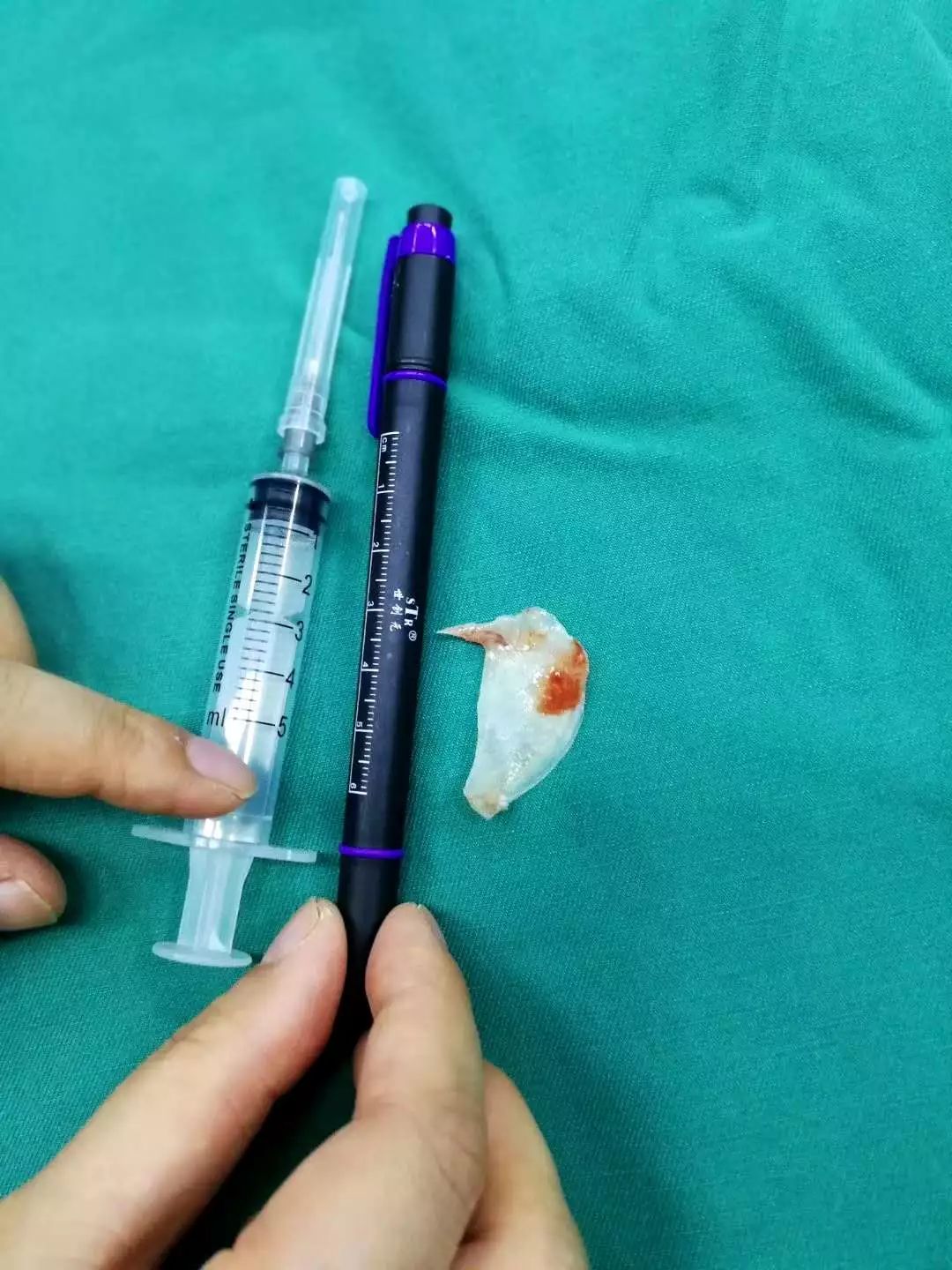 南宁男子吃到鱼刺竟强行吞下,男子吃饭误吞鱼刺