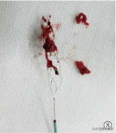 是不是有的血栓也不要过度治疗,能彻底治疗血栓吗