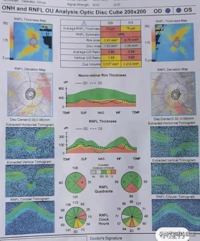 眼底检查塌陷,眼底筛查充血