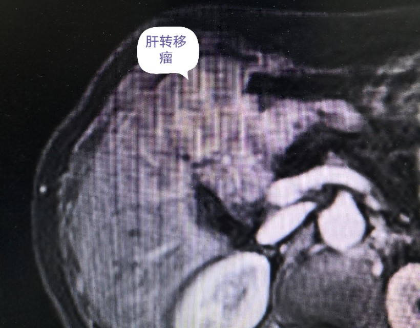 胆管癌癌症病人晚期,胆管癌晚期转移了要住院还是在家