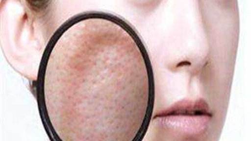 脸上毛孔粗大怎么办要如何改善,脸上毛孔粗大用什么办法解决最好