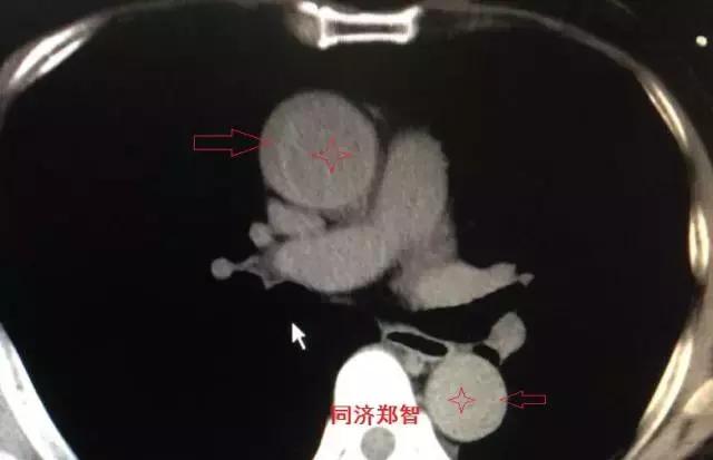 磁共振可以替代cta检查主动脉夹层,主动脉夹层cta上如何分辨真假腔