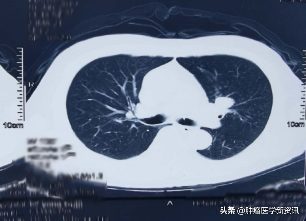 抗癌物质能治愈癌症吗,抗癌成功的几率有多大