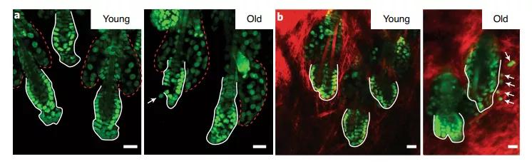 秃头是因为毛囊坏死吗,毛囊干细胞治疗秃头