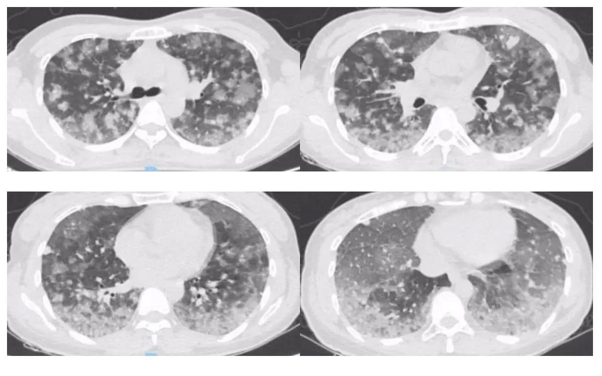 弥漫性肺泡出血能治好吗,弥漫性肺泡出血能活多久