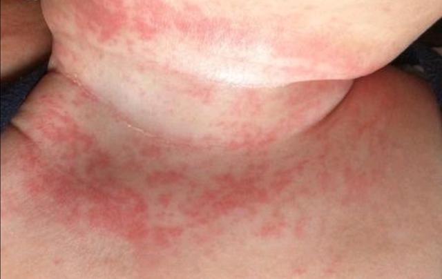 宝宝湿疹护理全过程手法,幼儿湿疹怎样正确干预