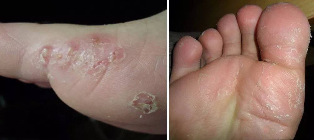 脚气脚臭脚痒的克星用什么,用什么泡脚可以治愈脚气