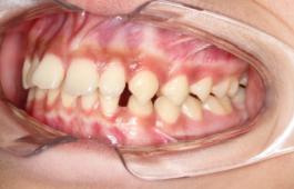 8岁的孩子能做牙齿矫正吗,7岁孩子矫正牙齿早吗