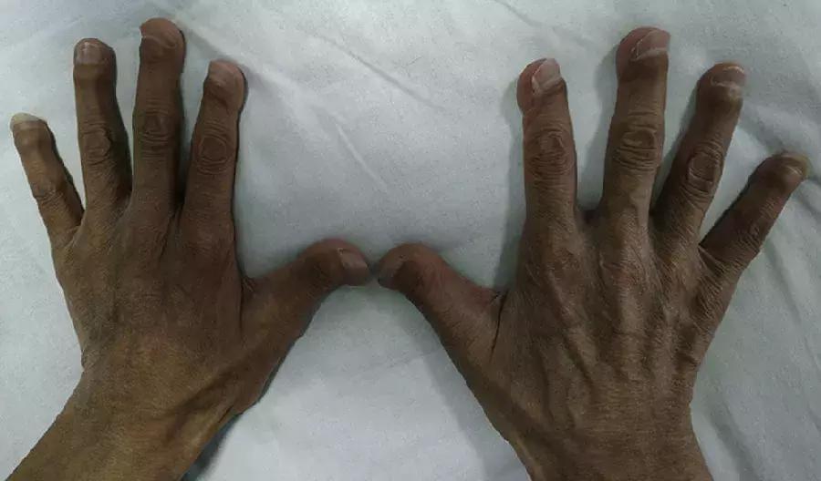 慢性肾病透析后肾还能恢复吗,慢性肾功能衰竭尿毒症透析