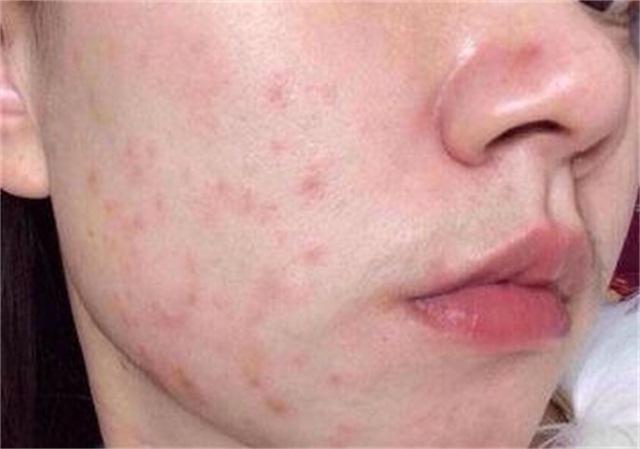 治疗激素脸敏感肌肤,激素脸屏障修护分享