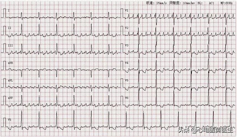 心房扑动是什么意思,心房扑动有什么症状